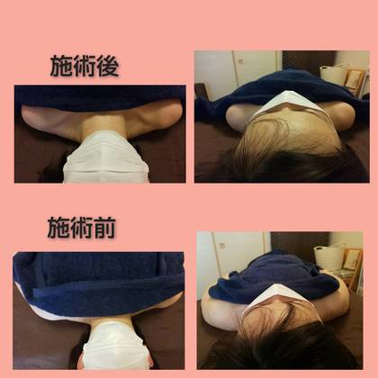 私筋膜リリースを受けました〜施術前と施術後